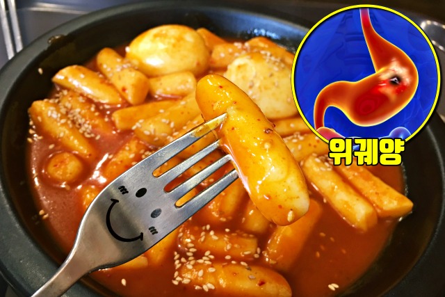 위궤양 원인, 위암, 매운음식, 떡볶이 위궤양 먹으면 안되는 음식