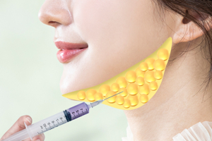 옆광대축소주사