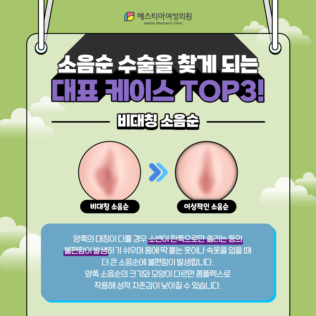 비대칭 소음순
