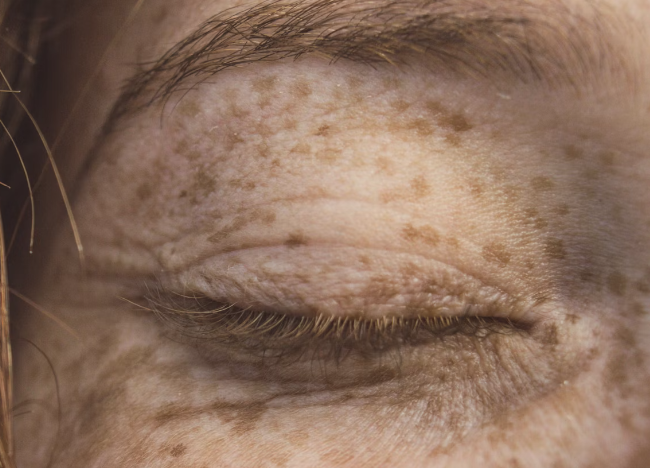 엉겅퀴 효능 : 피부 노화