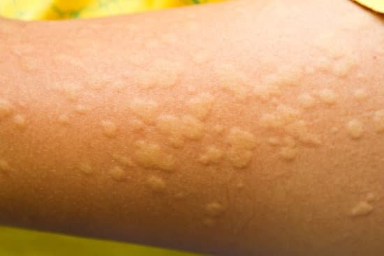 두드러기(Urticaria): 원인, 증상, 치료법