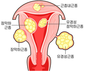자긍근종