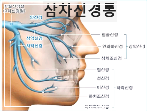 삼차신경통 증상