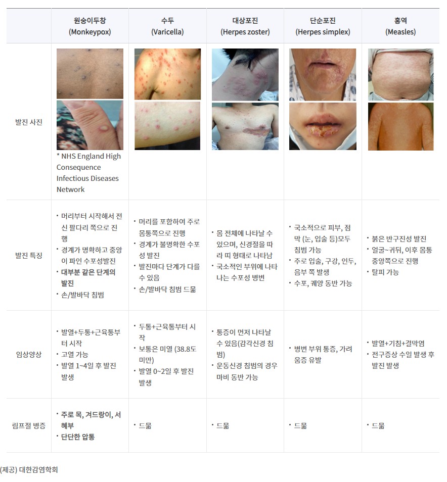 엠폭스와 다른 피부질환의 차이점