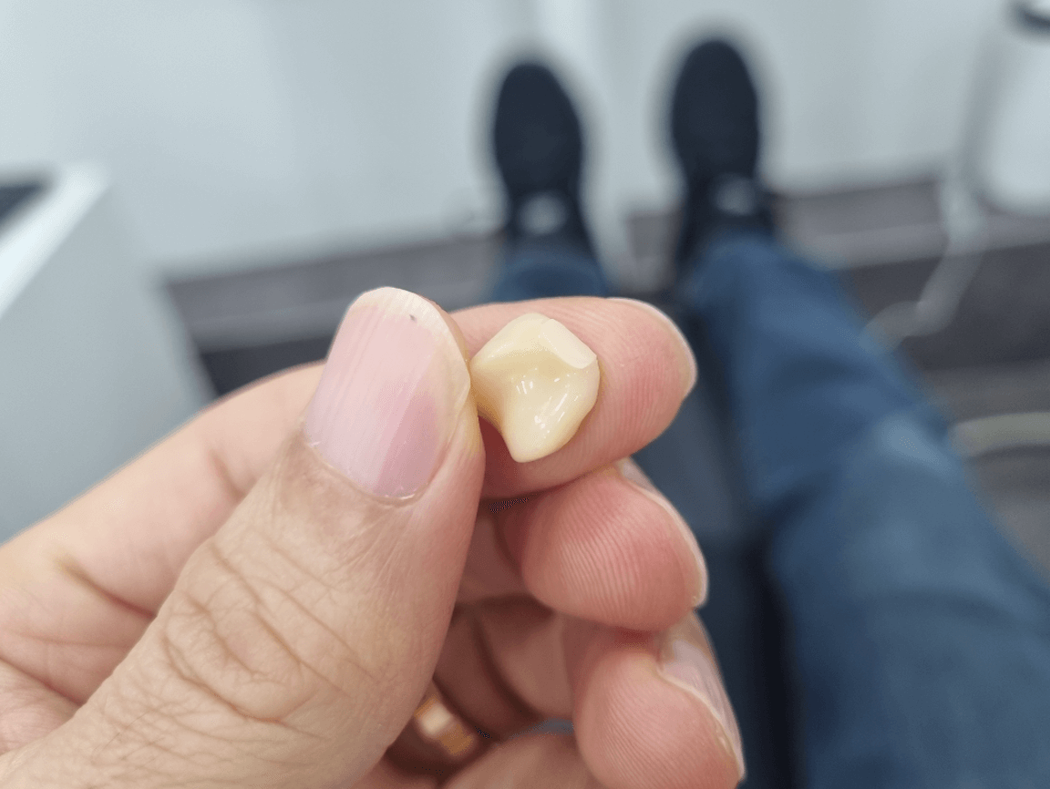 지르코니아 크라운 깨짐