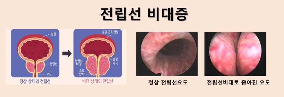 전립선비대증 상태