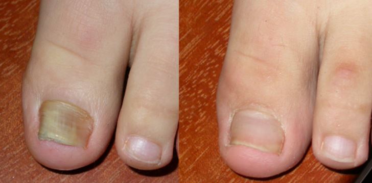 differences-between-dermatological-treatments-and-pharmacy-athlete-foot-medications