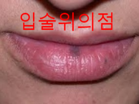 입술 위의 점