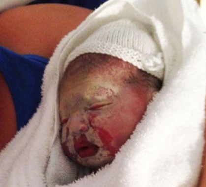 콜로디온 베이비, 층판비닐증이라는 이름은 생소하지만, 이 질병은 태어난 아기들 중 드물게 발생하는 특이한 피부 질환입니다. 이 피부 질환은 특이한 증상들과 함께 새로운 부모들을 놀라게 하고 있으며, 이에 대한 정보와 치료법이 필요합니다.