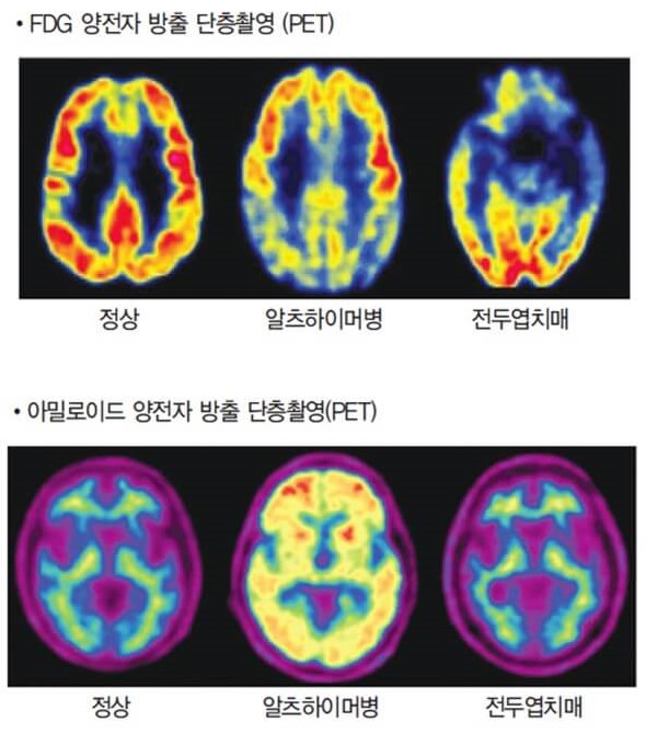 뇌영상 검사법