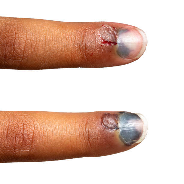 손톱 세로줄과 가로줄 원인이 당뇨와 암일까요? 손톱에 색깔이 변하거나 이상이 생기면 암을 생각할 수 있는데요~ 그 증상들과 관련이 있는지 참고하시기 바랍니다.