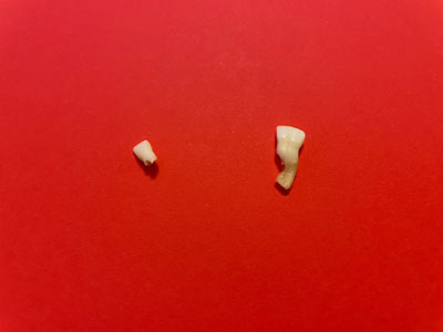 융합치 발치 후기 - 뜻, 이유, 발치 시기 등 총정리