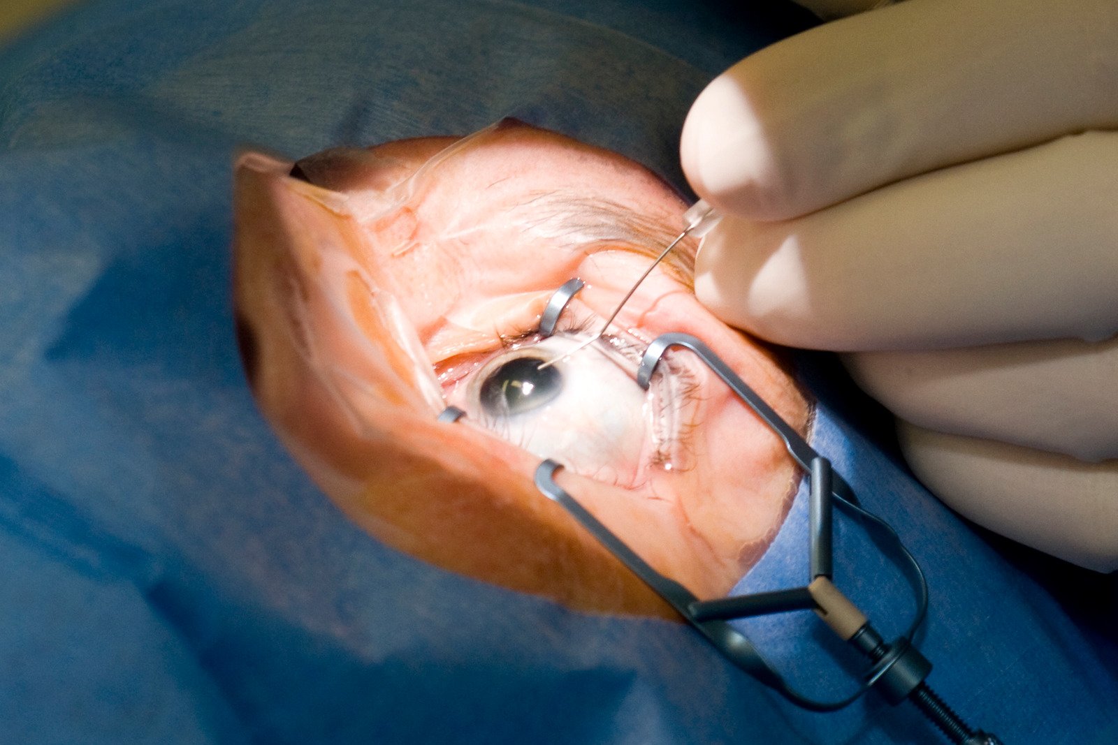Trabeculectomy
