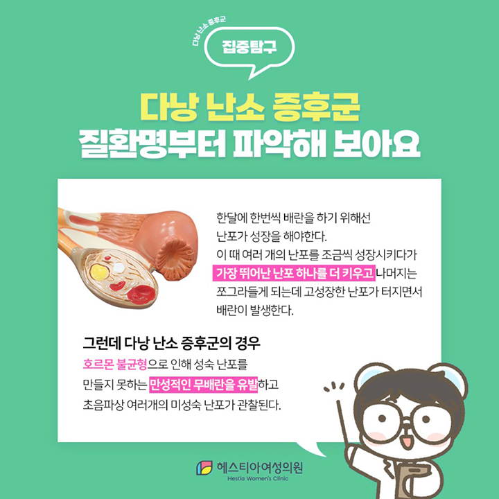 다낭 난소 증후군이란