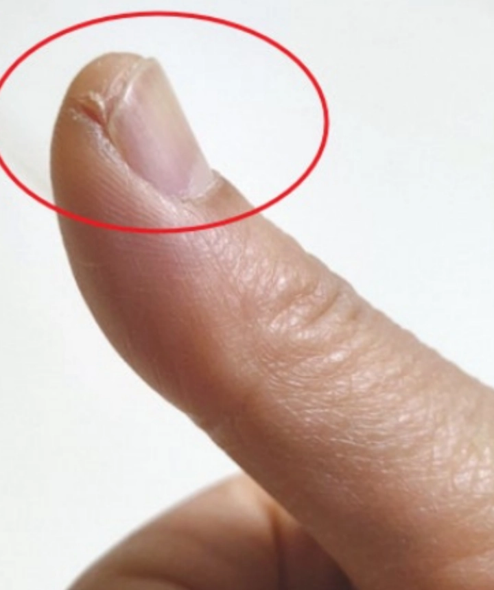 손끝-갈라짐