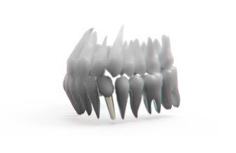 임플란트 가격 특징 정리