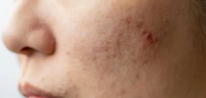 볼쪽에 여드름이 있는 사진