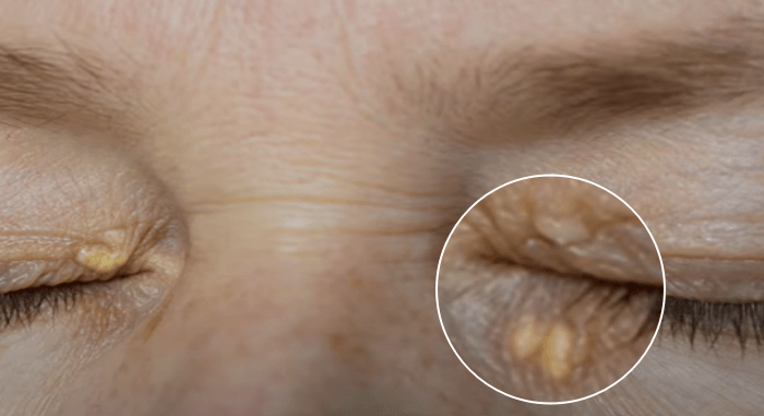 고지혈증증상황색종