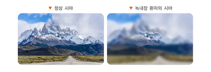 정상시야-녹내장시야