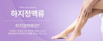하지정맥류 
