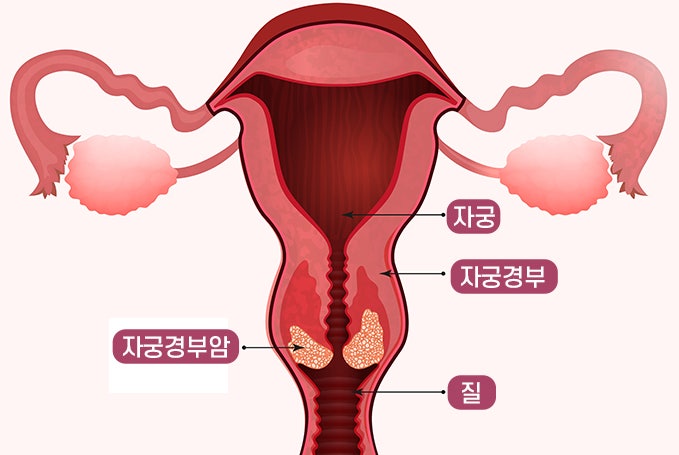 자궁경부암 설명