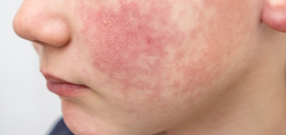 안면홍조의 증상, 원인