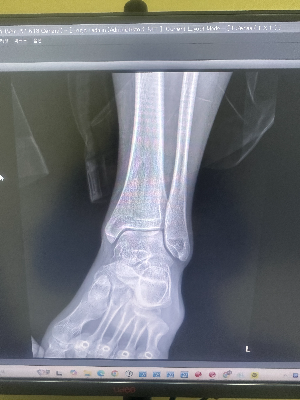 방사선사 모니터에서 확인하는 족관절 X-ray 발목 모티스 뷰(Mortise View) 촬영 영상