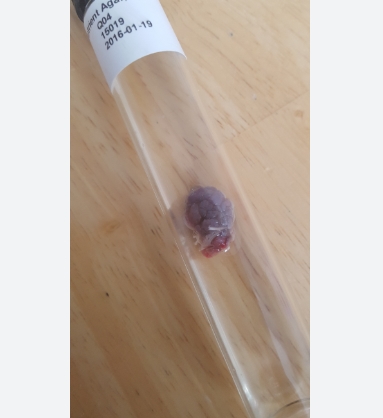 쥐젖 제거방법