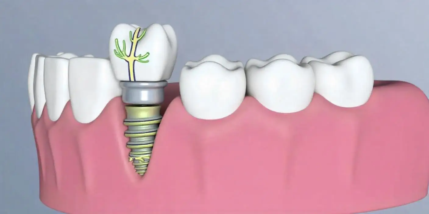 임플란트 시리즈 이미지 6