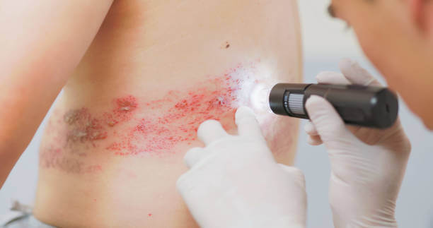 대상포진 예방접종 비용확인 초기증상 치료