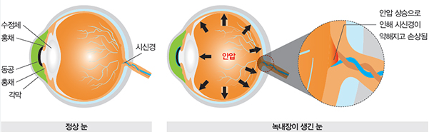 녹내장 완전 가이드