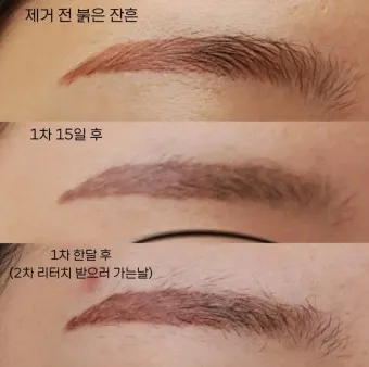 눈썹 문신 제거 방법 꿀팁_7