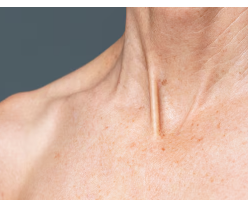 피부암 초기증상 13