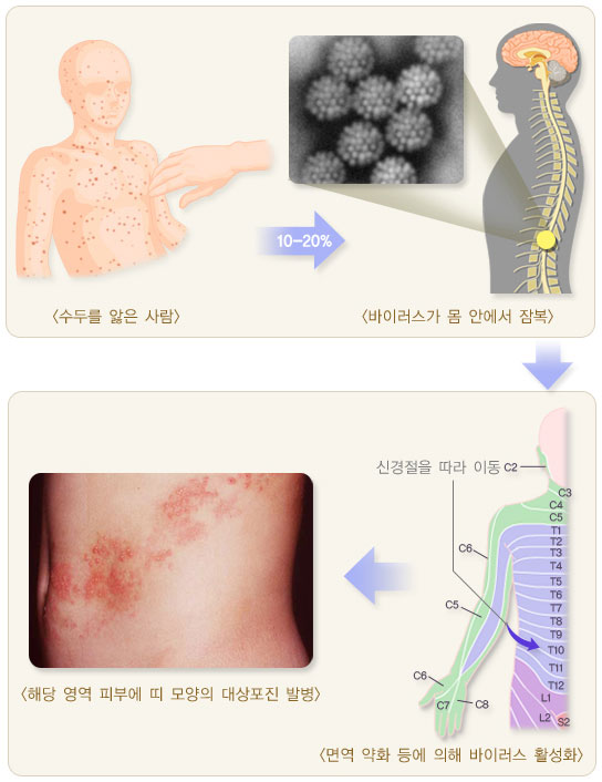 대상포진 초기증상