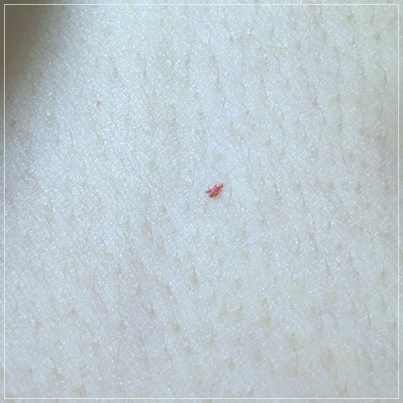 몸에-빨간점이-생기는-이유