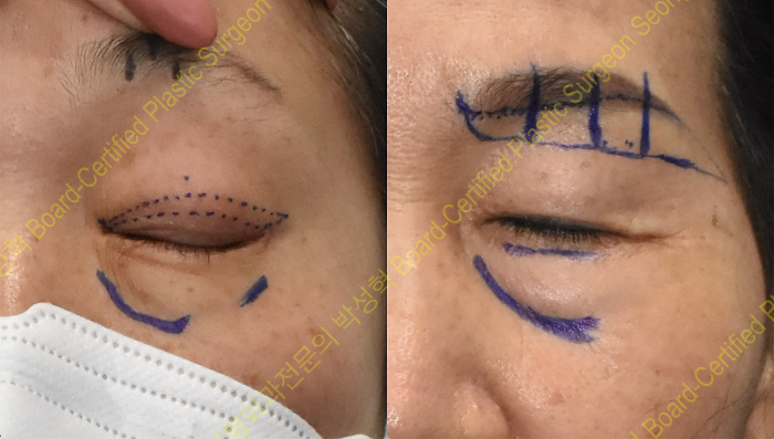 상안검-눈썹하거상-디자인