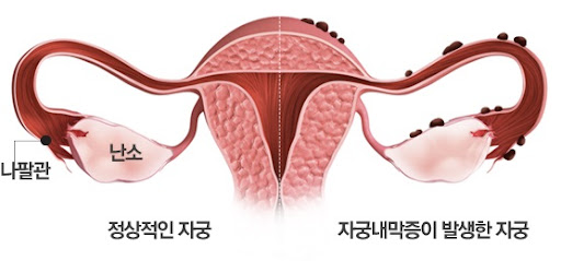 자궁내막증