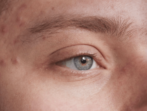 아연, 여드름피부