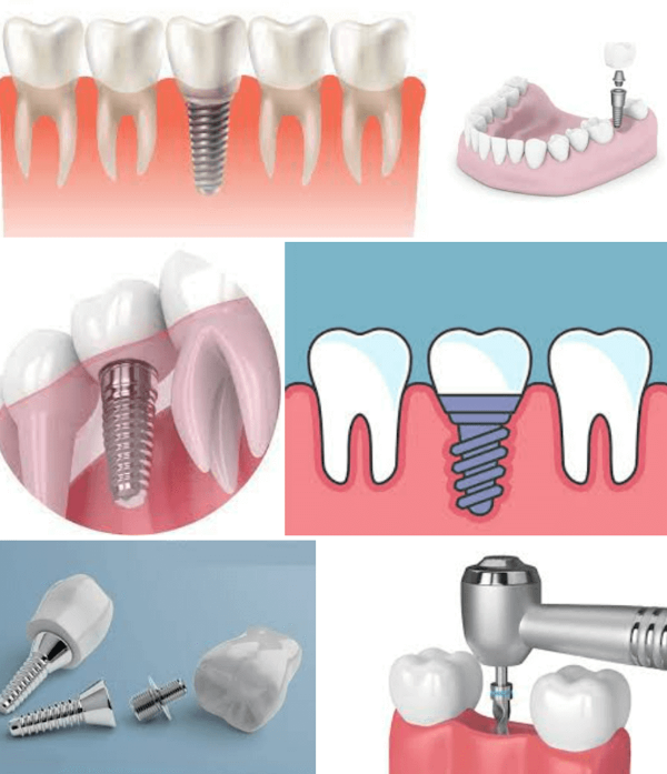 임플란트 부작용 시술과정 임플라는 치료를 하는 이유