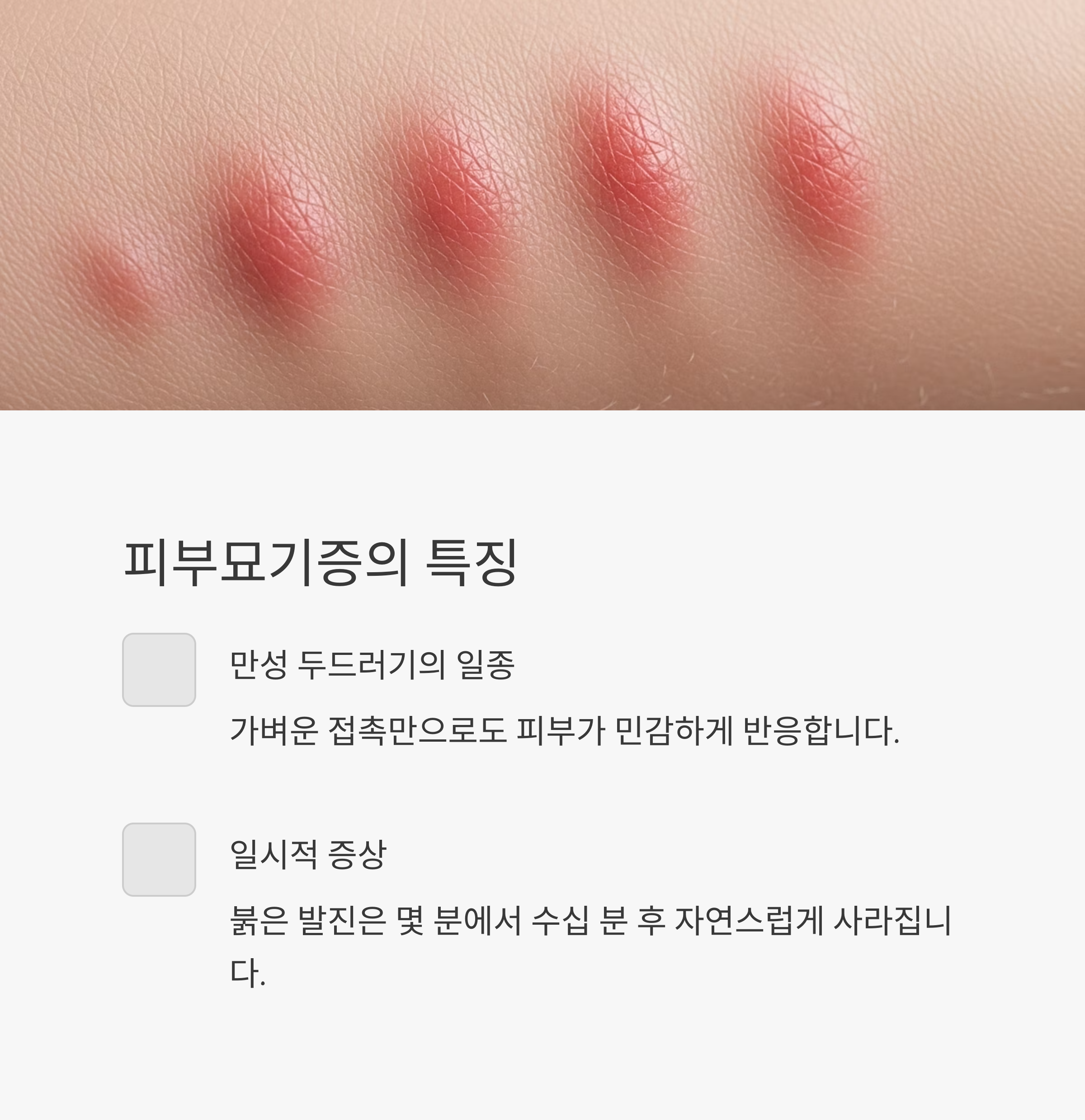 피부묘기증의 특징