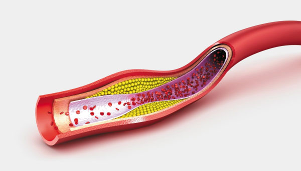 혈관이 좁아진 그림