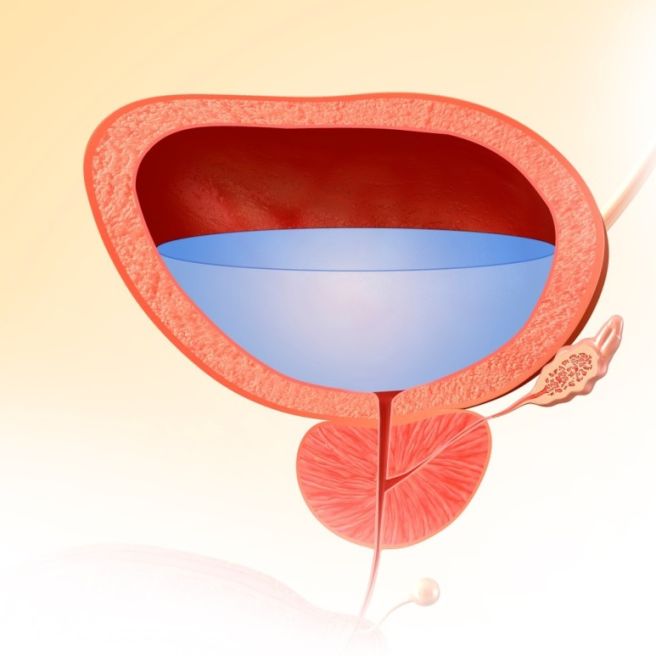 요실금 치료방법