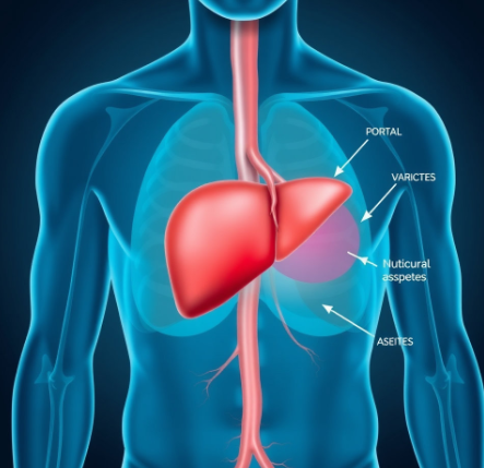 양수색전증그림