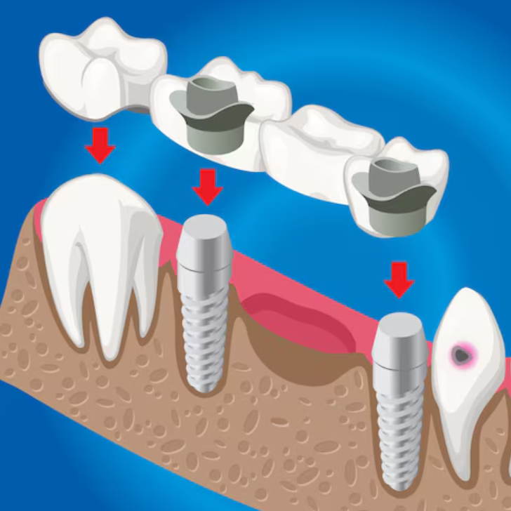임플란트 종류 시니어