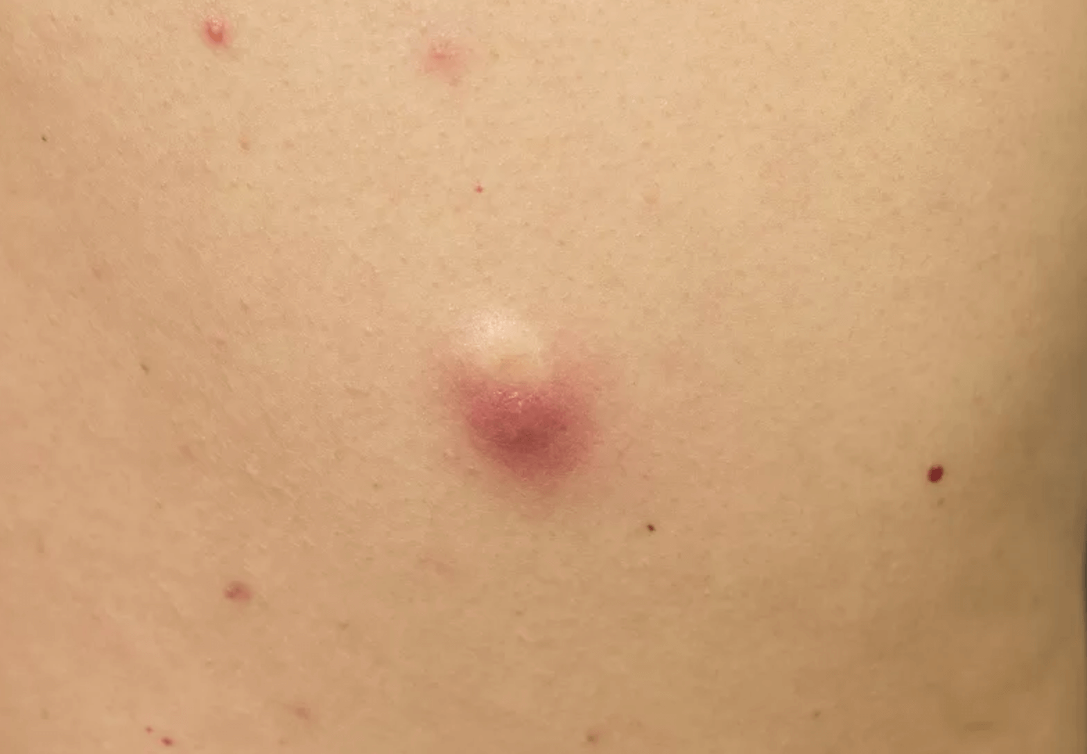 피지낭종-제거비용