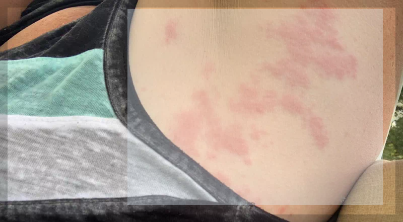 겨드랑이 대상포진