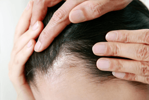 탈모에 좋은 음식02