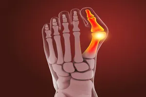 무지외반증-수술비용