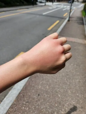 모기 물려 가려울 때 땀띠에 안티푸라민 연고 효능 부작용 사용후기_20