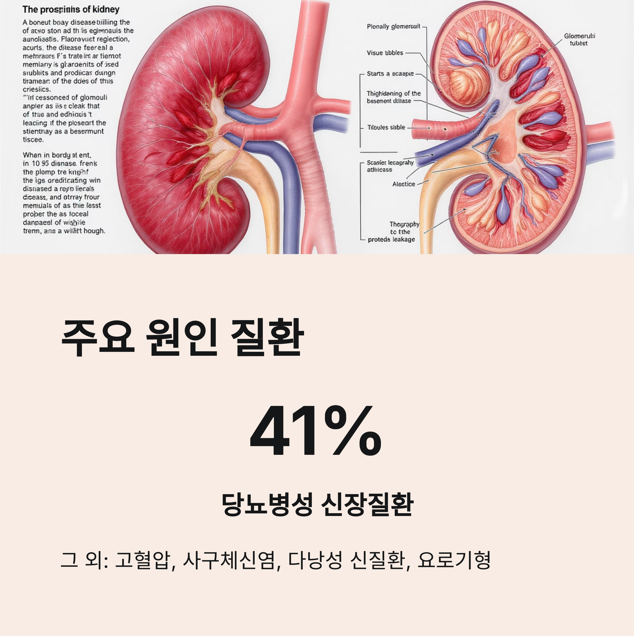 신장의 해부학적 일러스트와 함께 당뇨병성 신장질환이 만성 신부전의 주요 원인임을 설명한 이미지